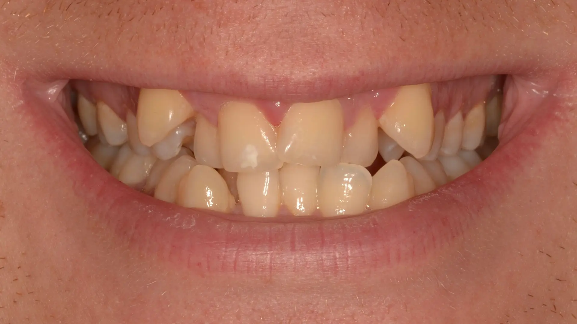 Discoloured, overlapping teeth before treatment