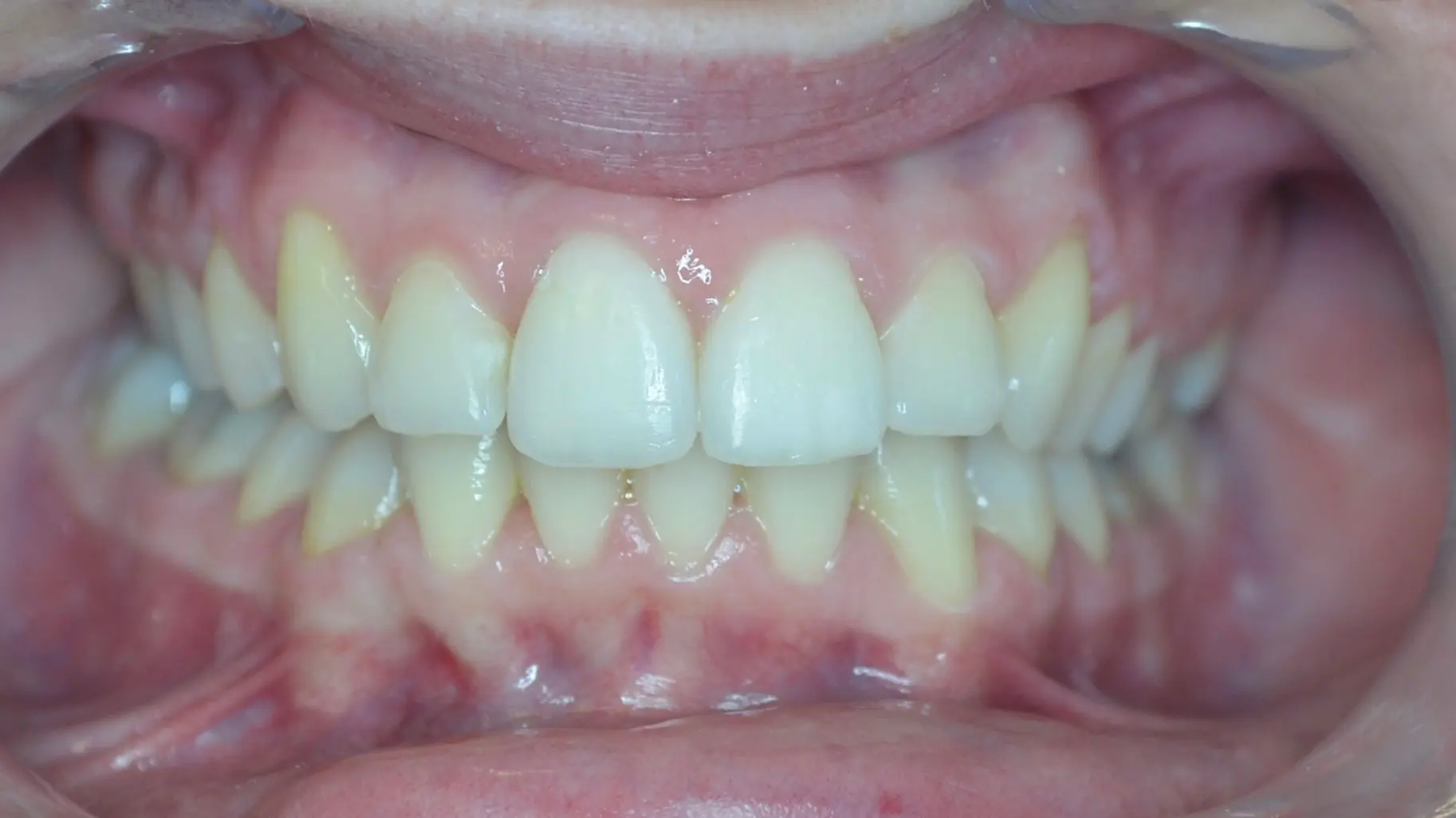 Straightened lower front teeth after orthodontic treatment