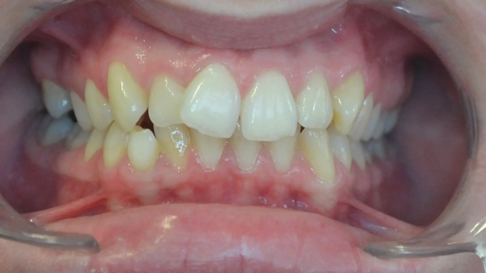 Crowded, rotated lower front teeth before orthodontic treatment