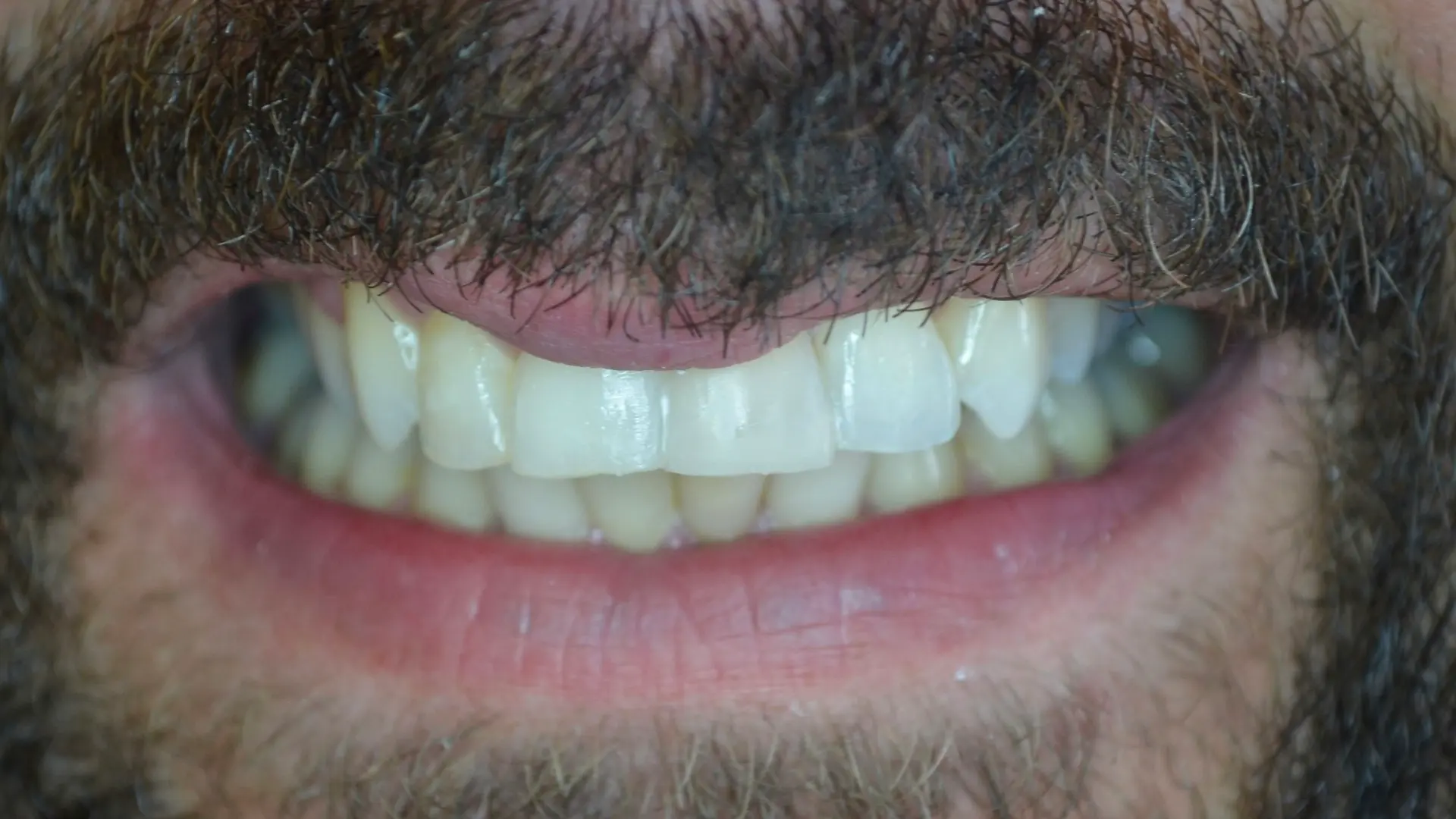 Straightened, even front teeth after orthodontic treatment