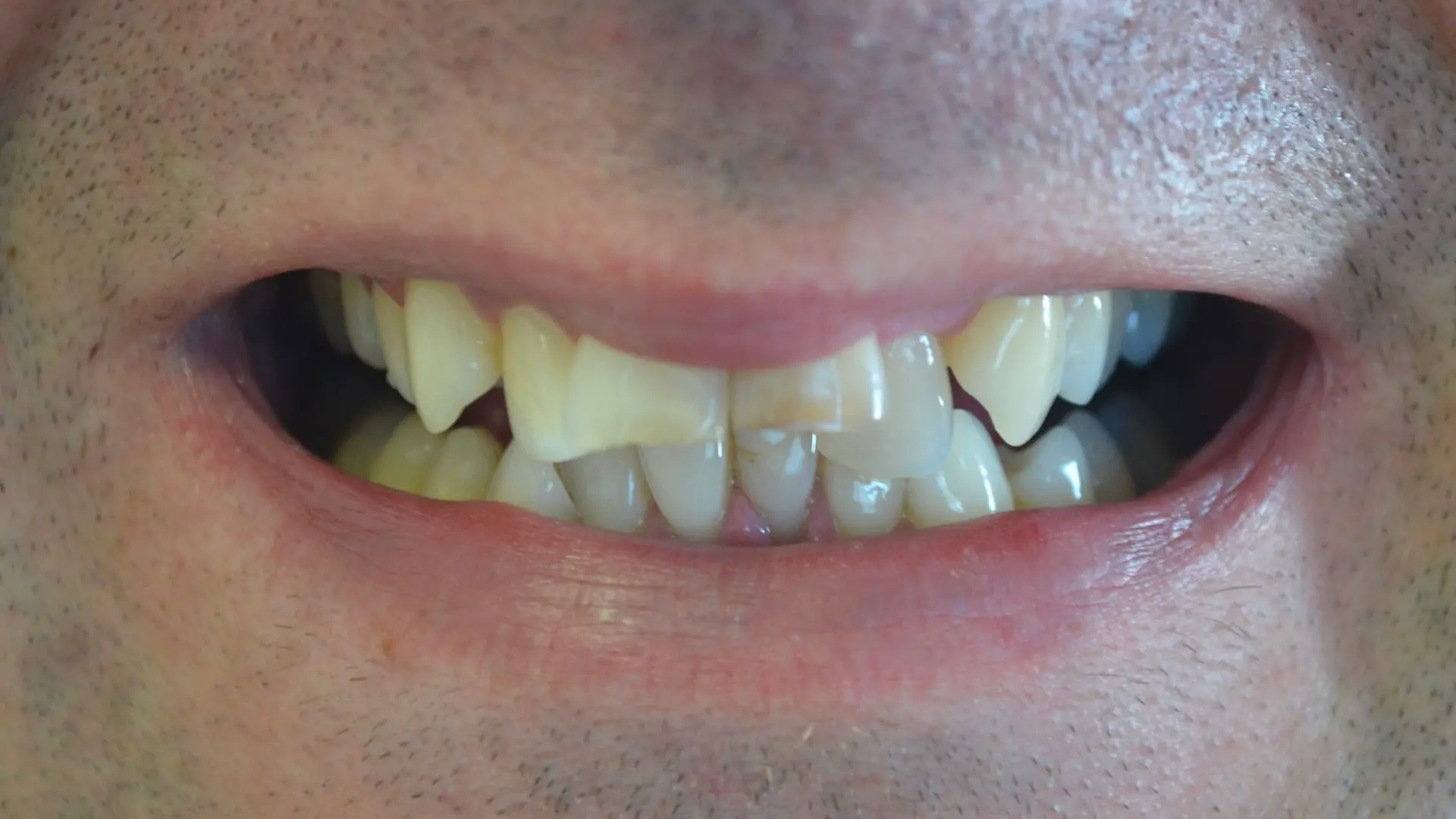 Severely misaligned, rotated front tooth before orthodontic treatment