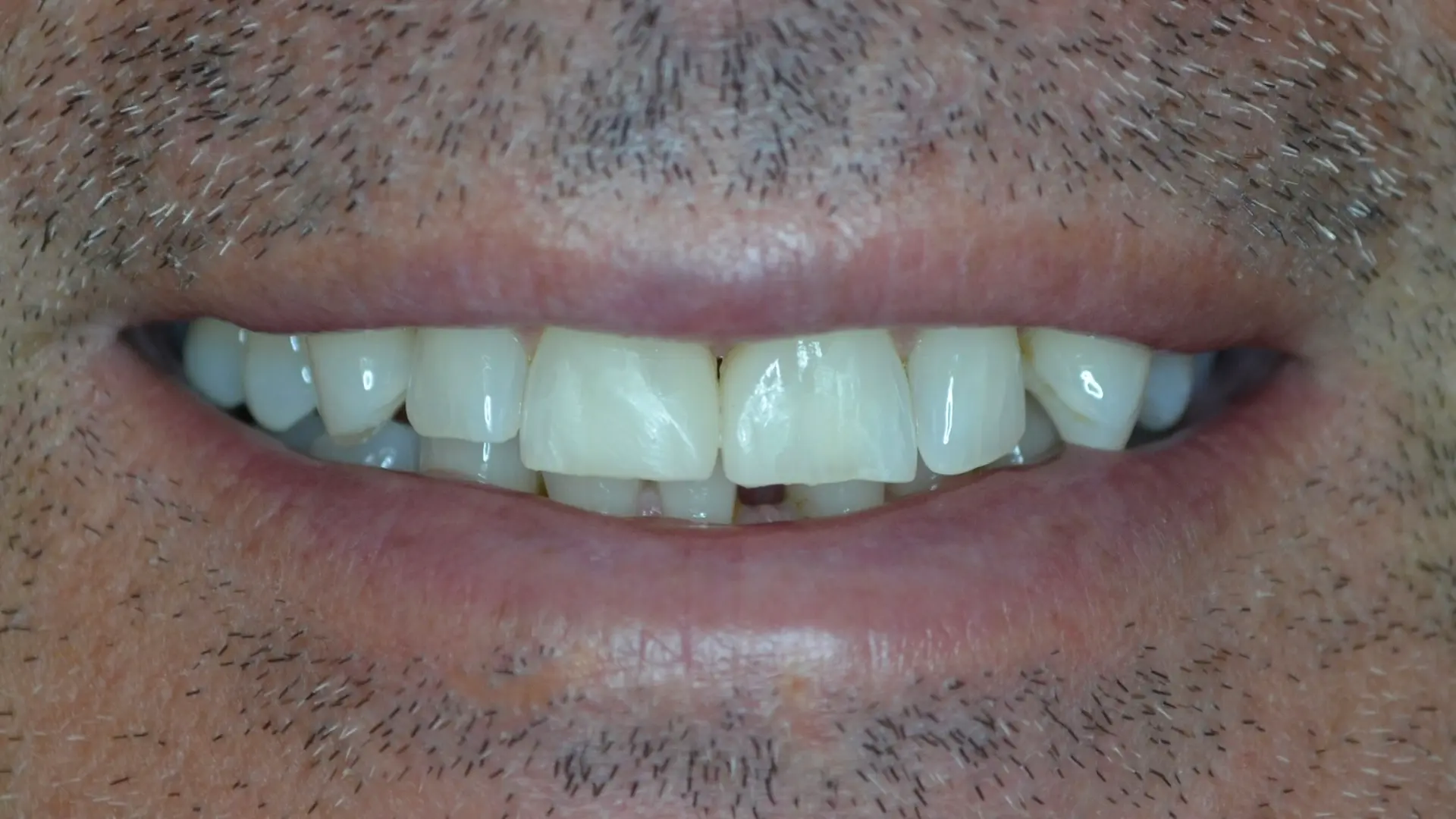 Gap between the front teeth closed after composite bonding