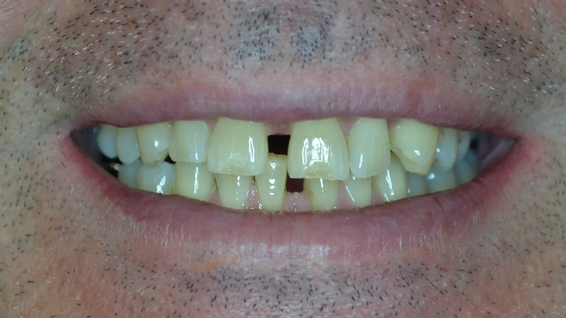 Visible gap between the front teeth before composite bonding