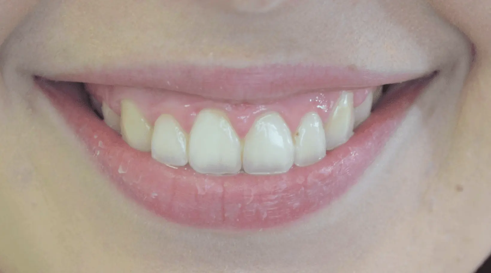 Reshaped, aligned front teeth after cosmetic treatment
