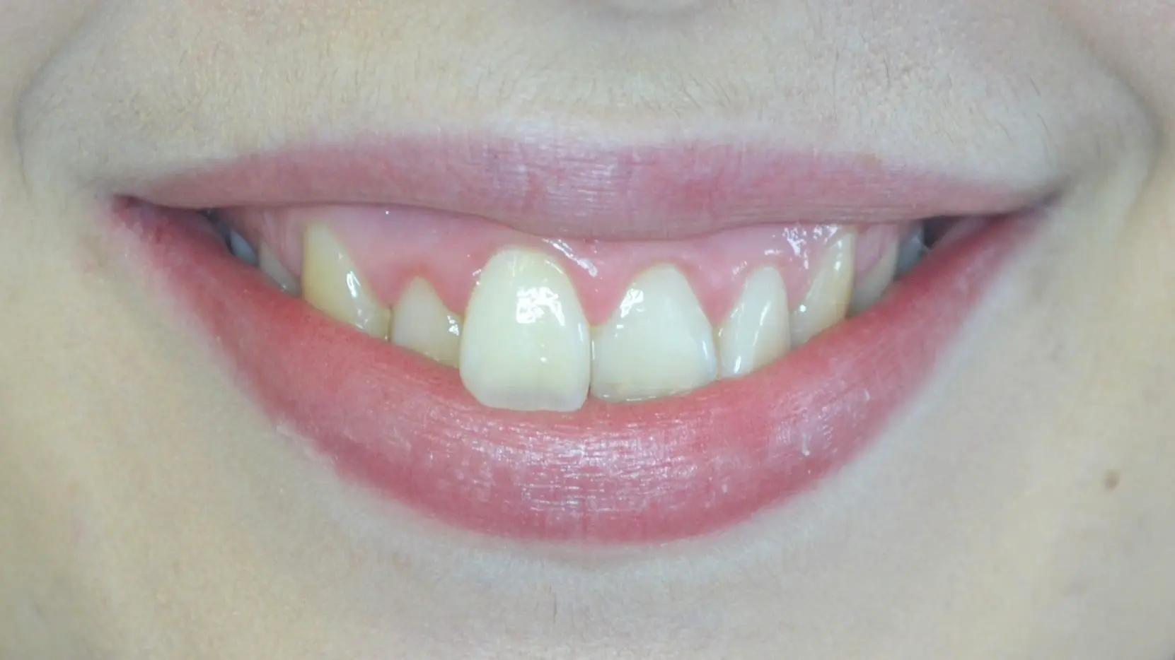 Recessed, uneven front teeth before cosmetic treatment