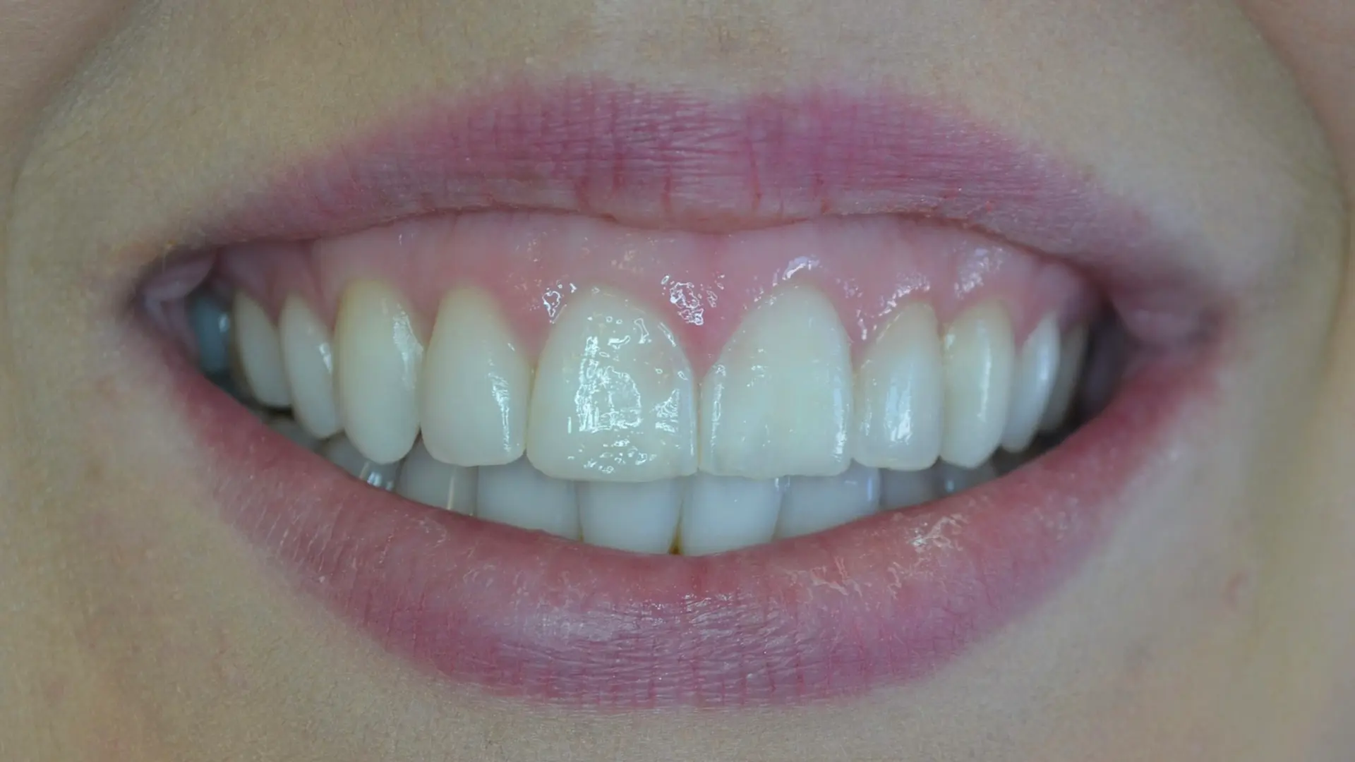 Reshaped, aligned front teeth after cosmetic treatment