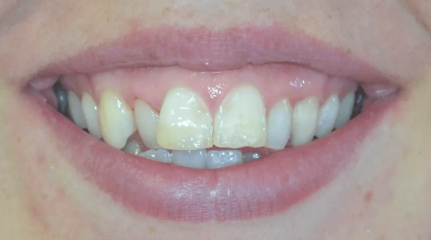 Discoloured, uneven front teeth before cosmetic treatment