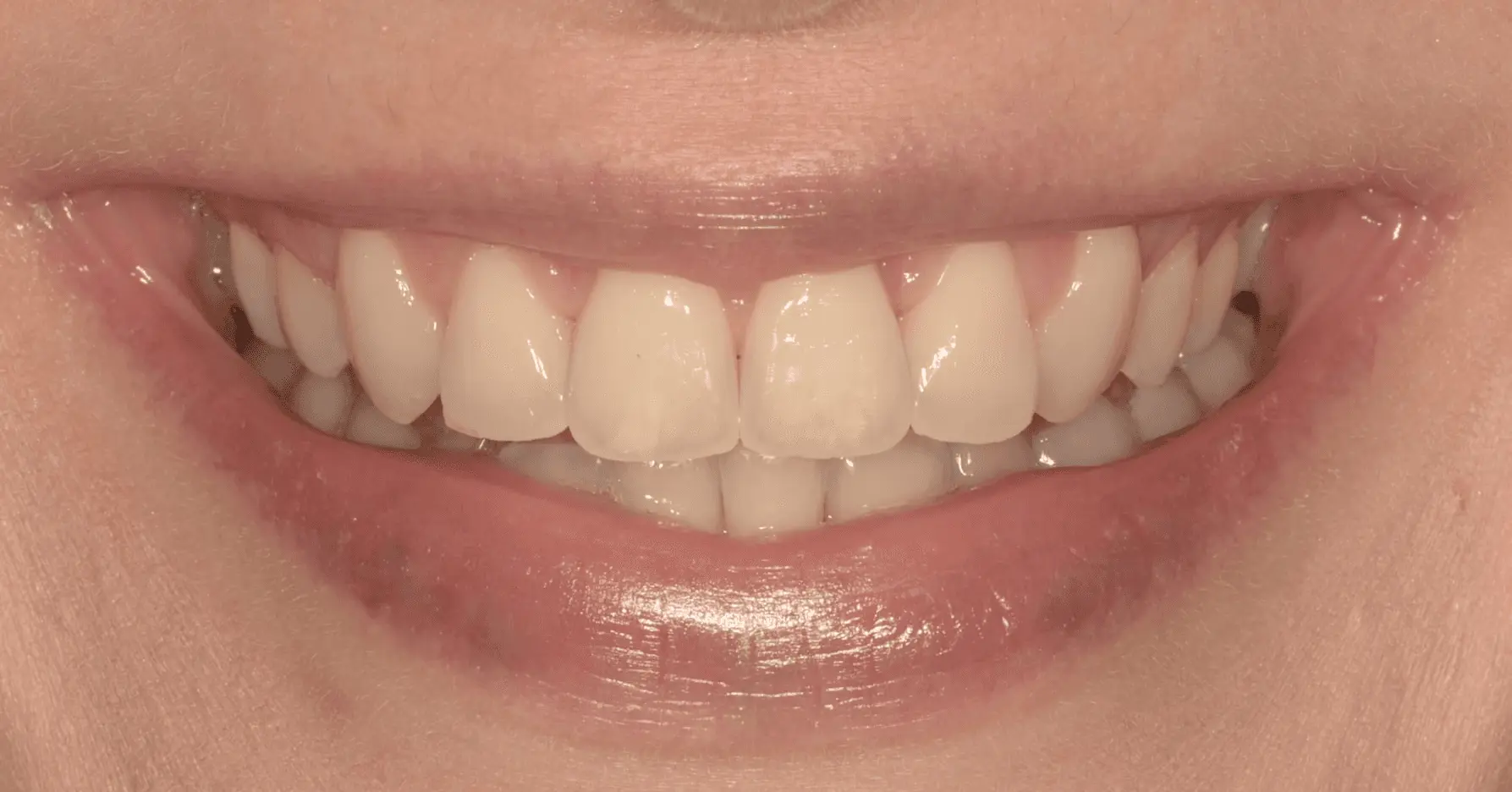 Whitened, reshaped smile after cosmetic treatment
