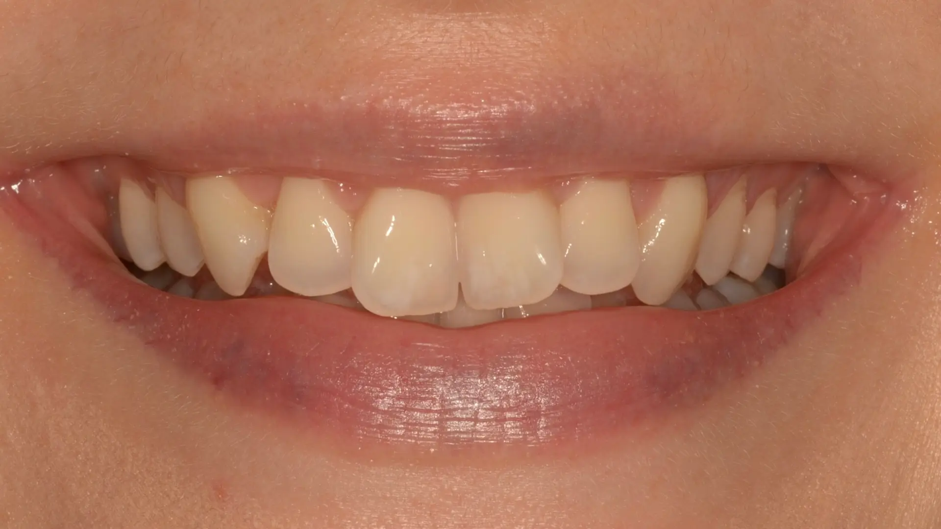 Chipped canine tooth edge before cosmetic treatment