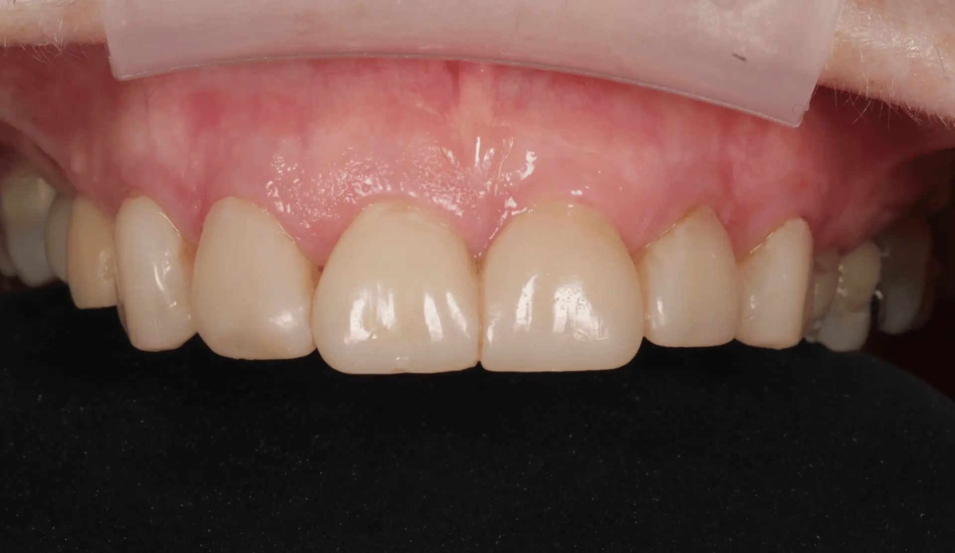 Restored, even front teeth after treatment (clinical retracted view)