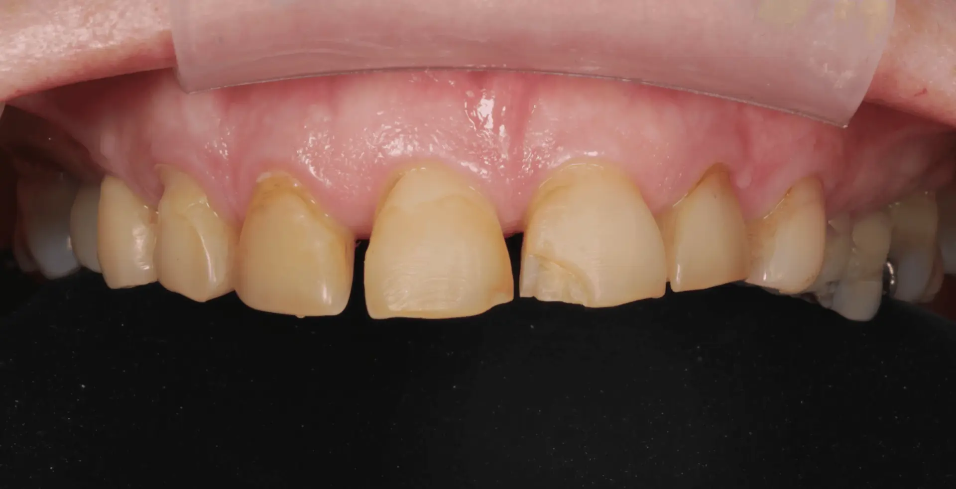 Heavily discoloured, cracked front teeth before restoration (clinical retracted view)