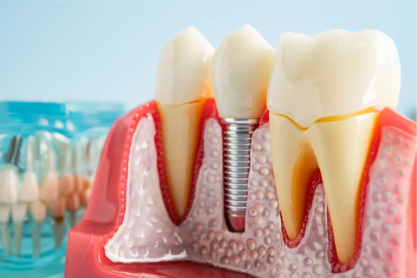 Dental implants vs dentures comparison