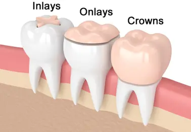 Biomimetic dentistry restoration diagram at Willerby Dental Care