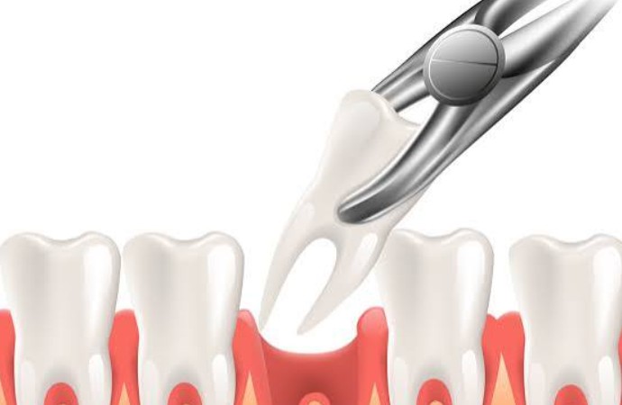 What to Expect After a Tooth Extraction: Recovery, Aftercare & Healing