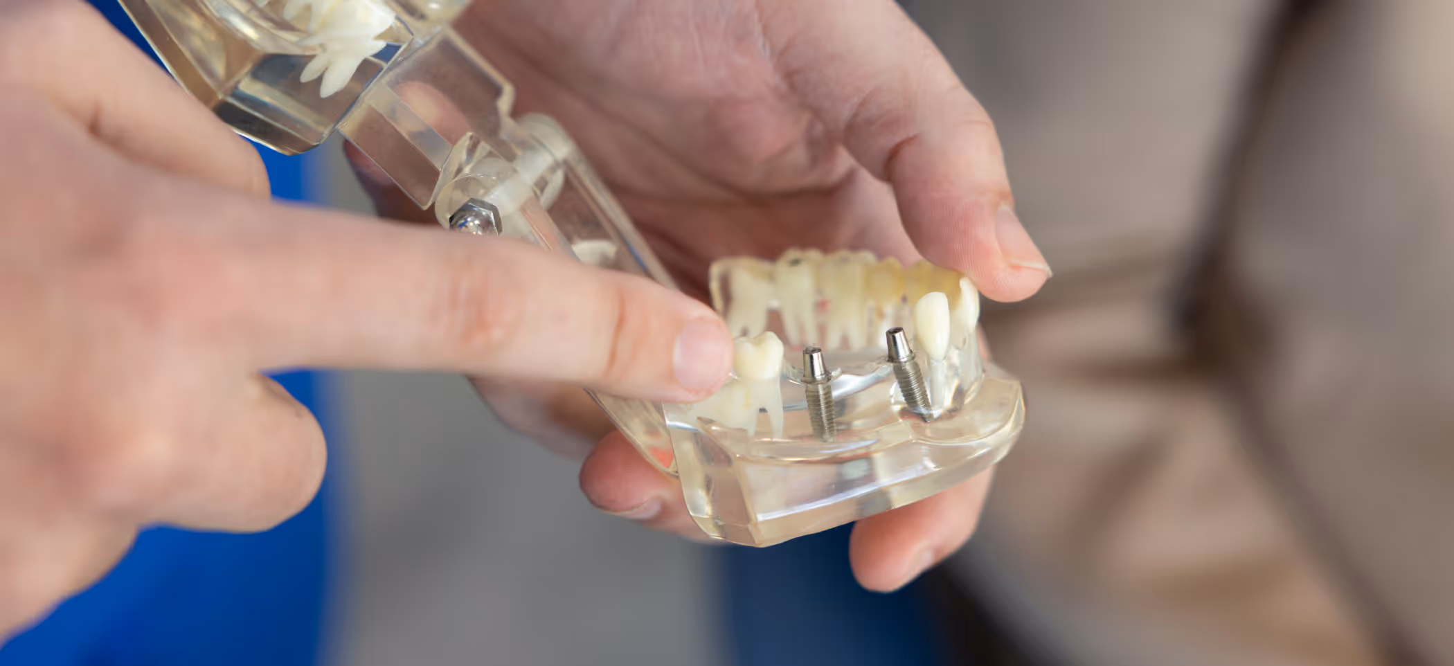 Dental Implants St. James, Long Island NY