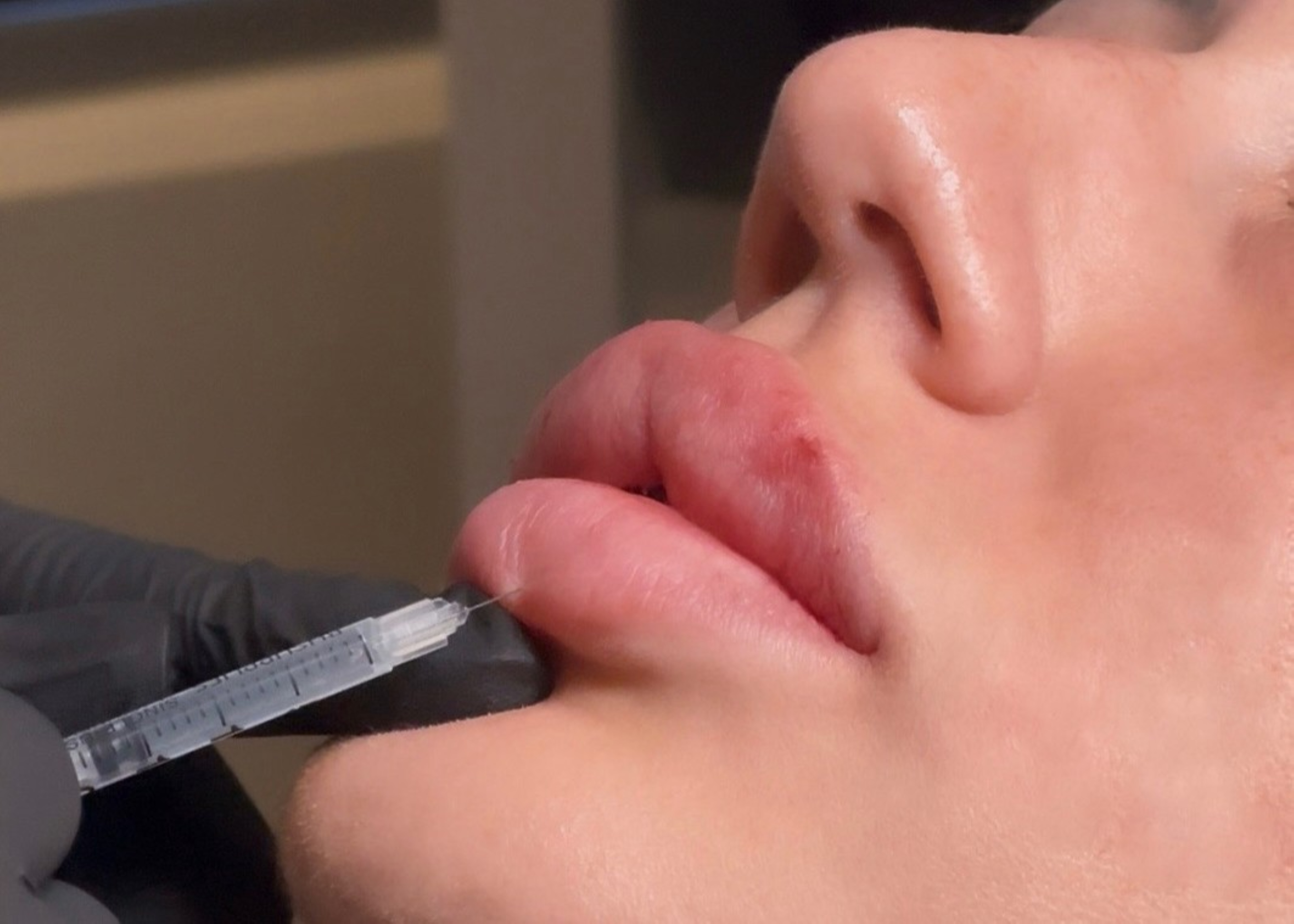 glutathione injections in murrieta ca Dermal Fillers | The Jab Lab