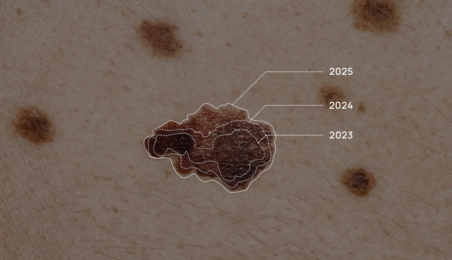 Skin mole with outlines showing changes in shape and color across years 2023, 2024, and 2025.