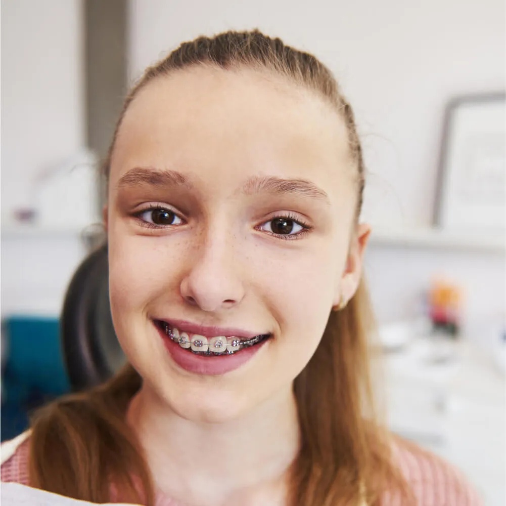 Braces Lite