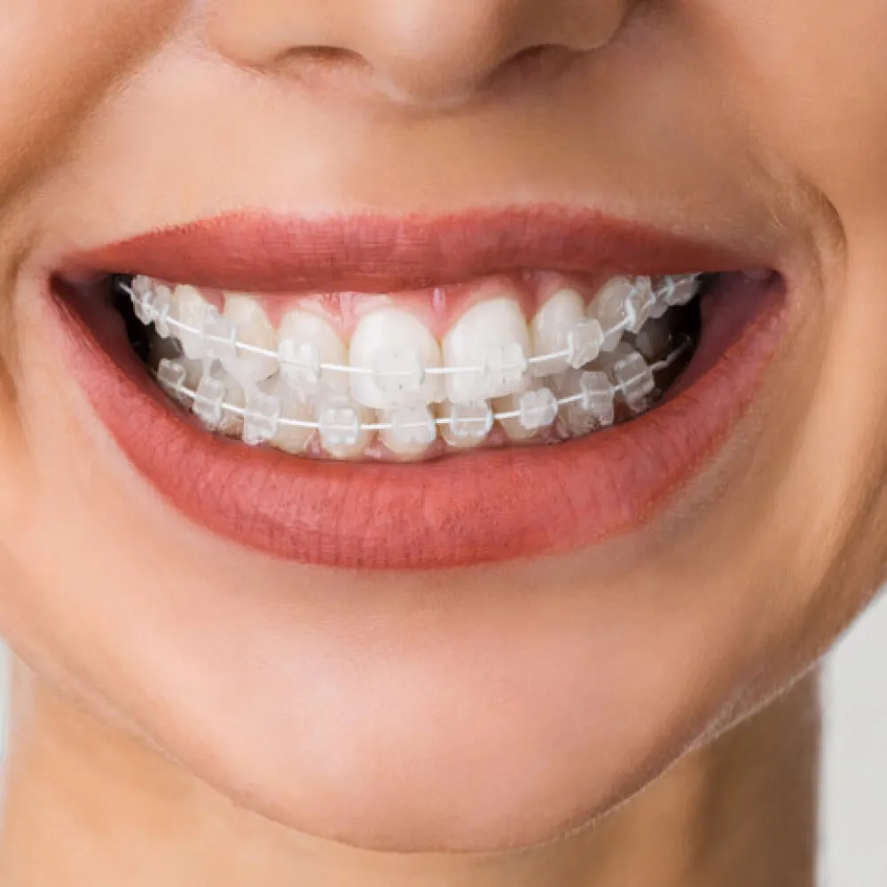 Clear Braces