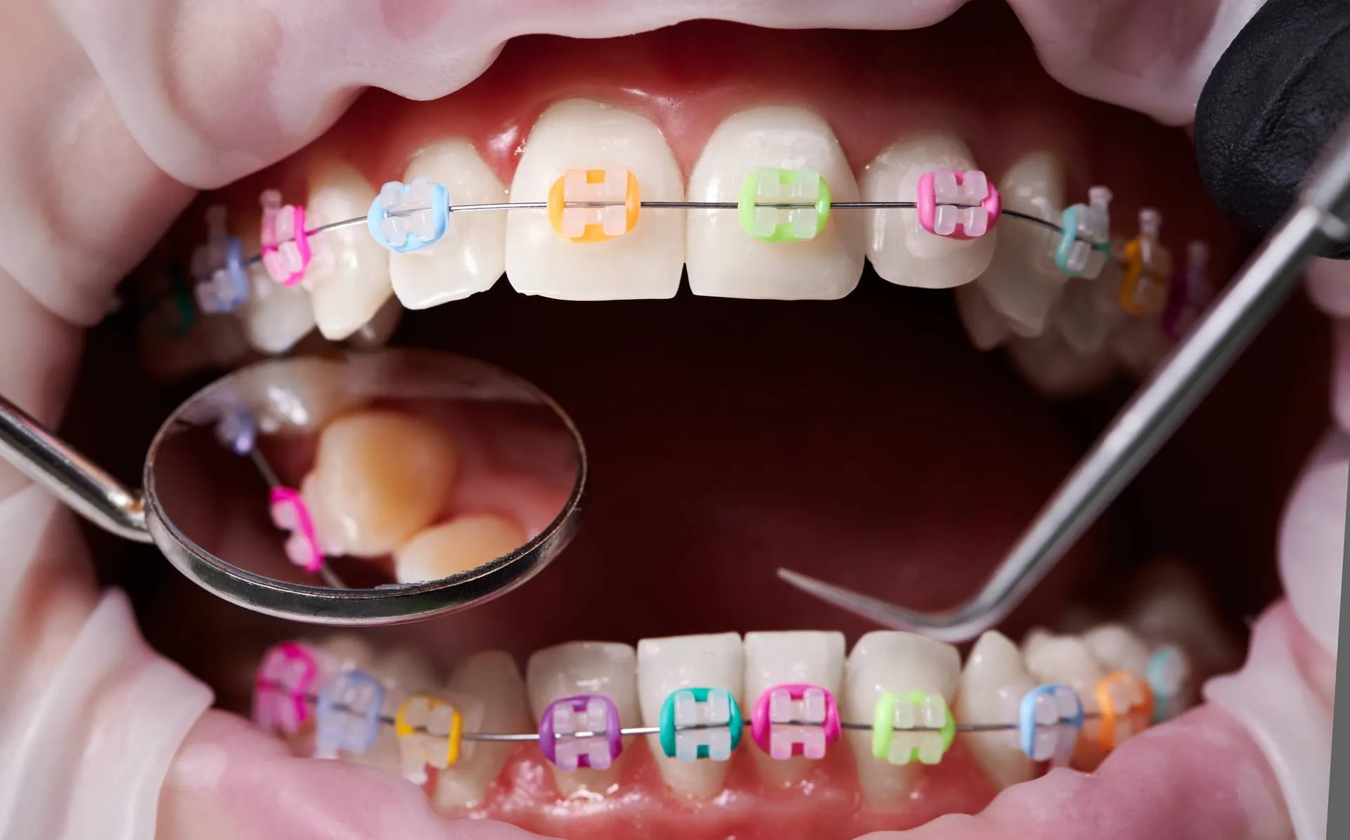 Coloured Braces