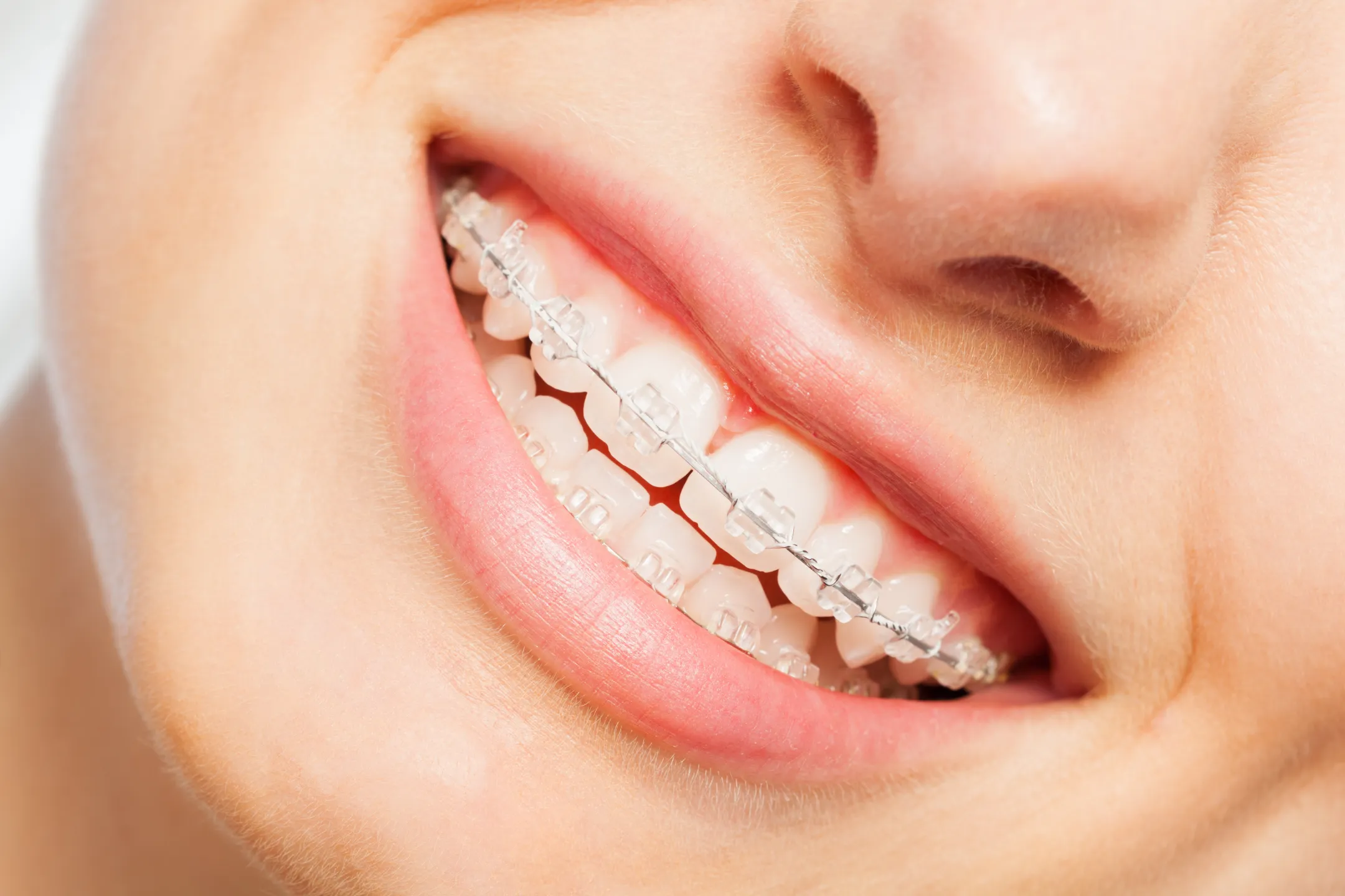 Exploring the Benefits of Ceramic Braces