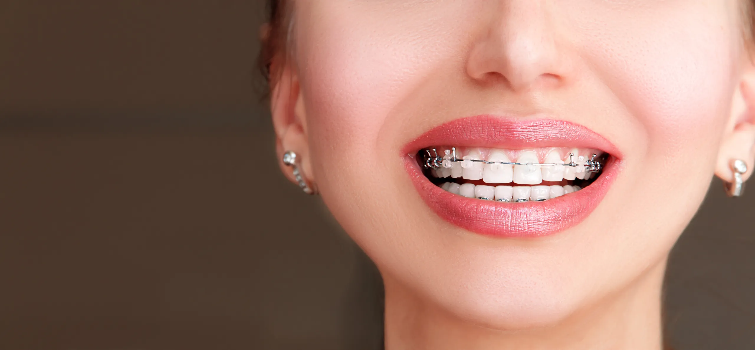 The Benefits of Self-Ligating Braces