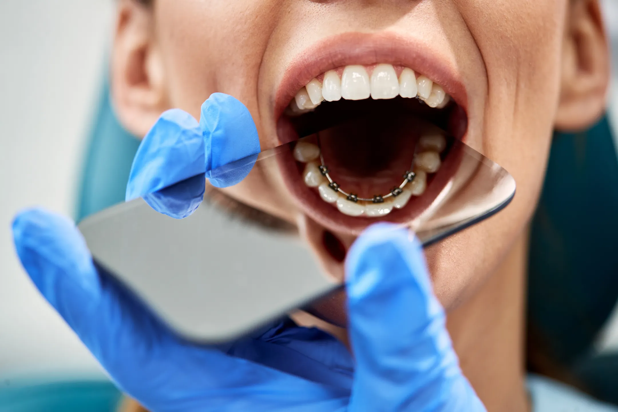 What Are the Advantages of Lingual Braces?