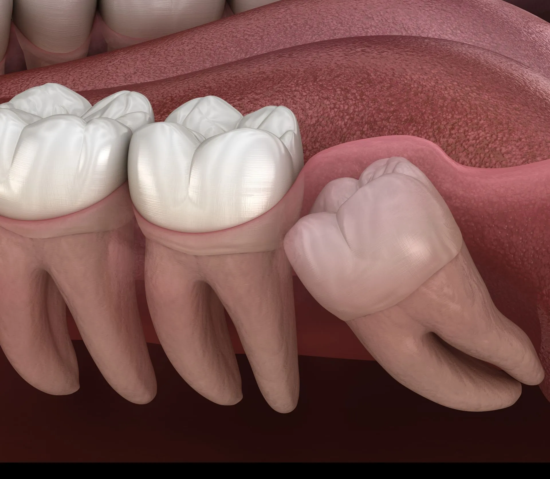 Wisdom teeth removal consultation at Brookhaven Village Dentistry in Brookhaven, GA