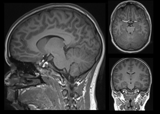 MRI scans of a human brain, seen from the side and from above.