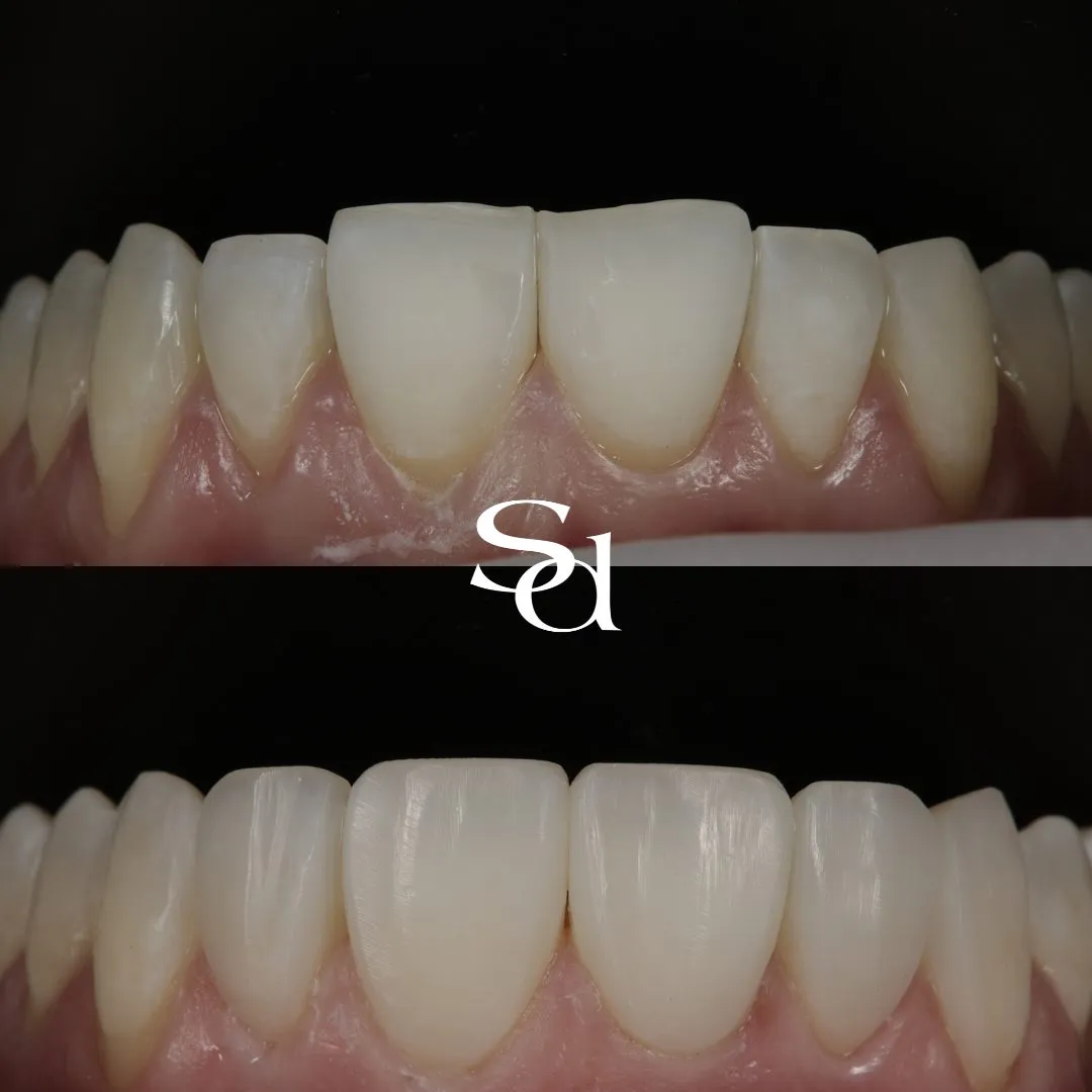 Before and after composite bonding at Sale Dental Spa, retracted view, un-retouched