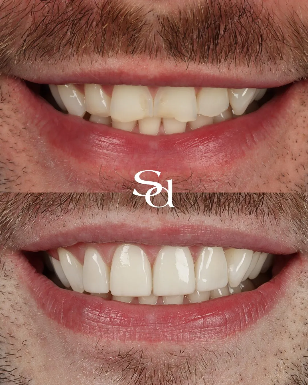 Before and after porcelain veneers at Sale Dental Spa, un-retouched