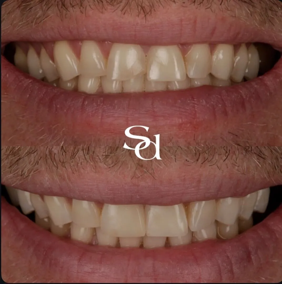 Before and after of a same-day emergency dental repair at Sale Dental Spa