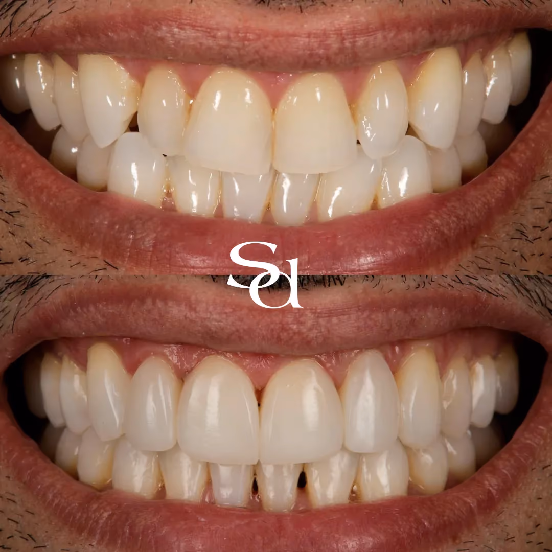 Invisalign and whitening before and after at Sale Dental Spa, un-retouched