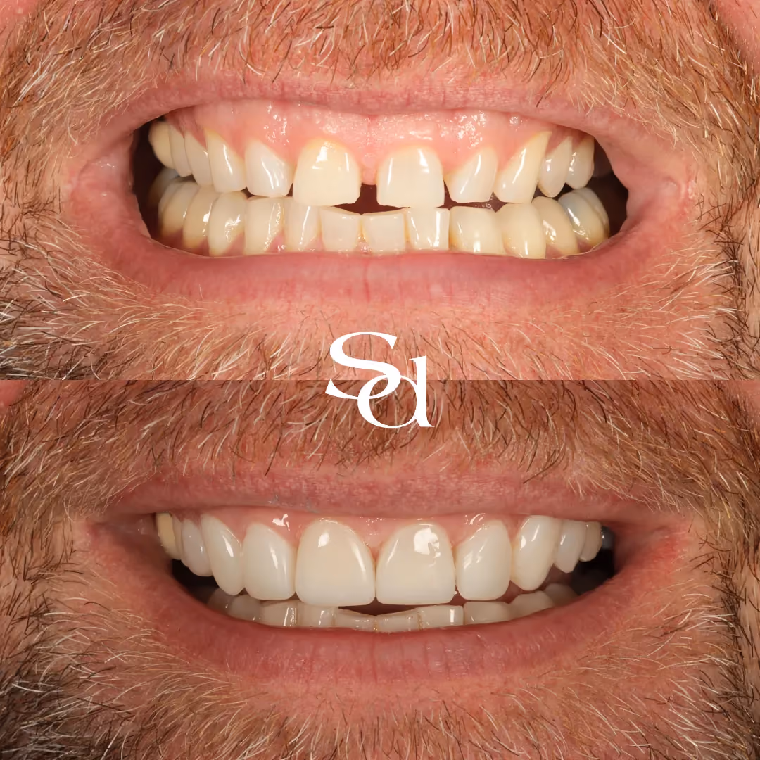 Composite bonding before and after at Sale Dental Spa: small, uneven teeth built up with composite bonding, by Dr Aisha Ahmed. Un-retouched.