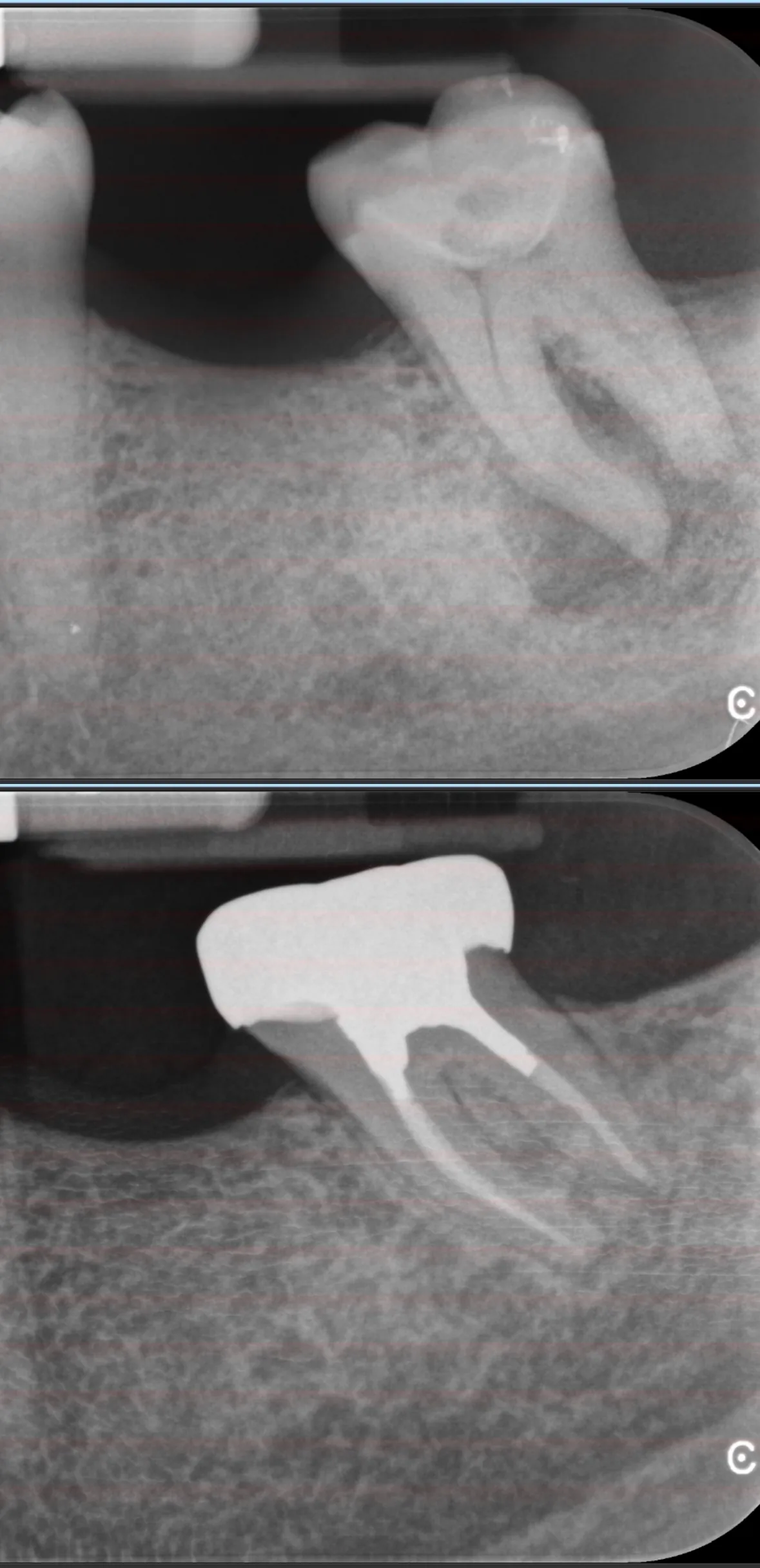 Pre-operative and post-operative periapical radiographs of a lower molar root canal treatment by Dr Sabeer
