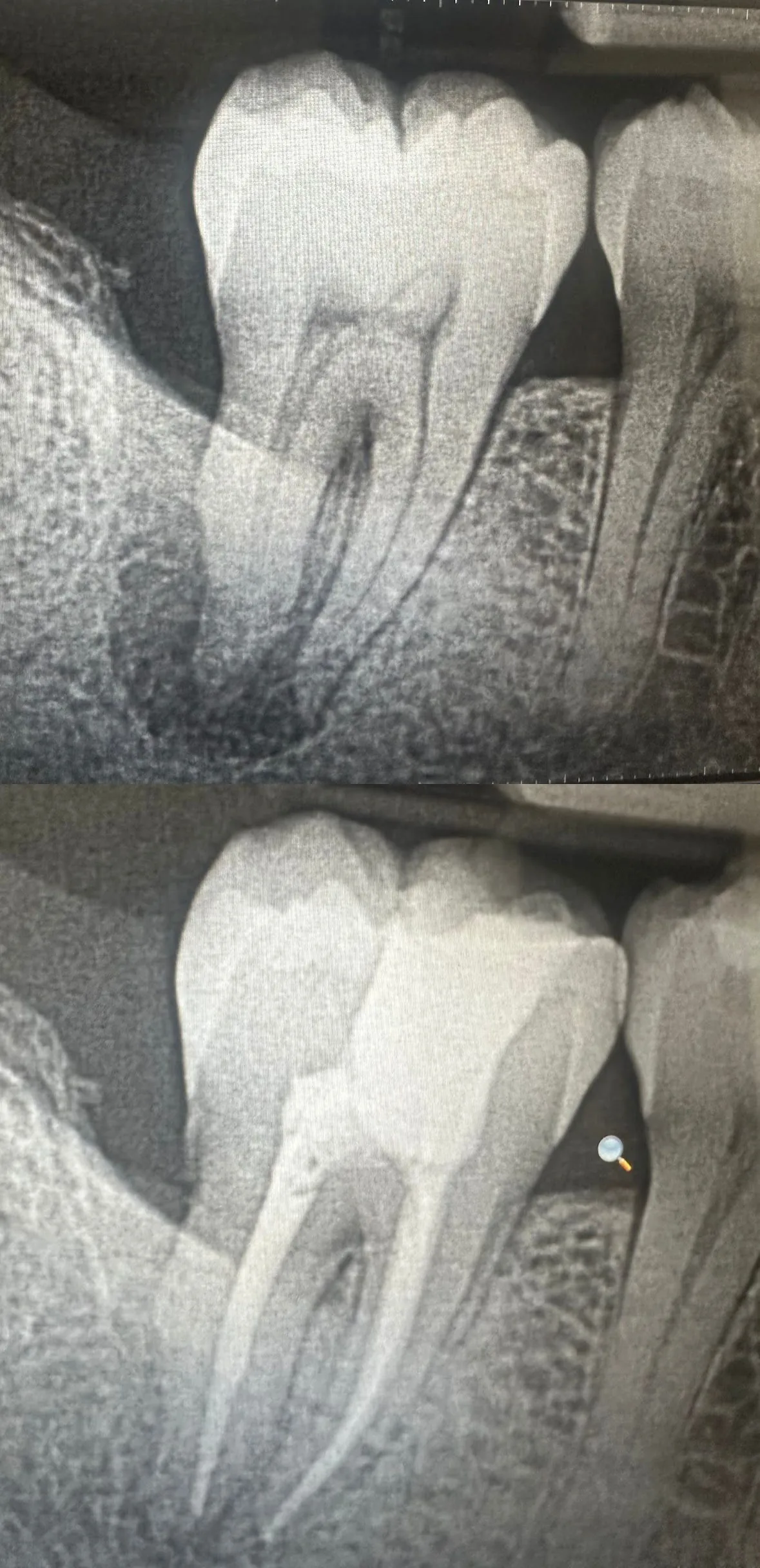 Pre-operative and post-operative periapical radiographs of a lower molar root canal treatment by Dr Sabeer