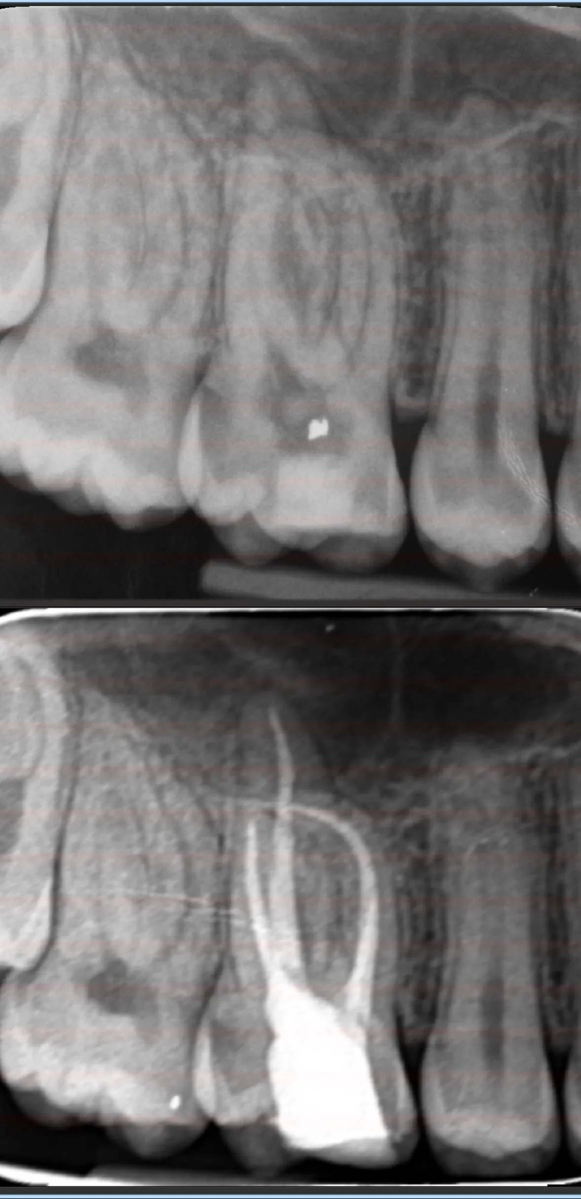 Pre-operative and post-operative periapical radiographs of an upper molar root canal treatment by Dr Sabeer