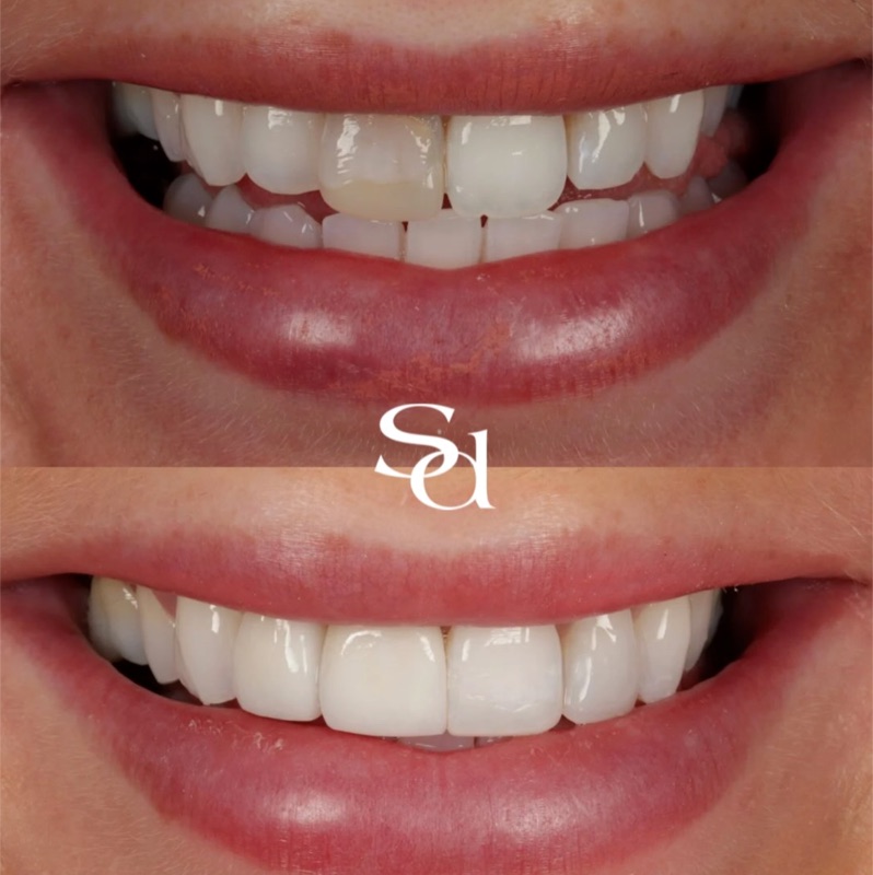 Before and after smile transformation, a real Sale Dental Spa patient