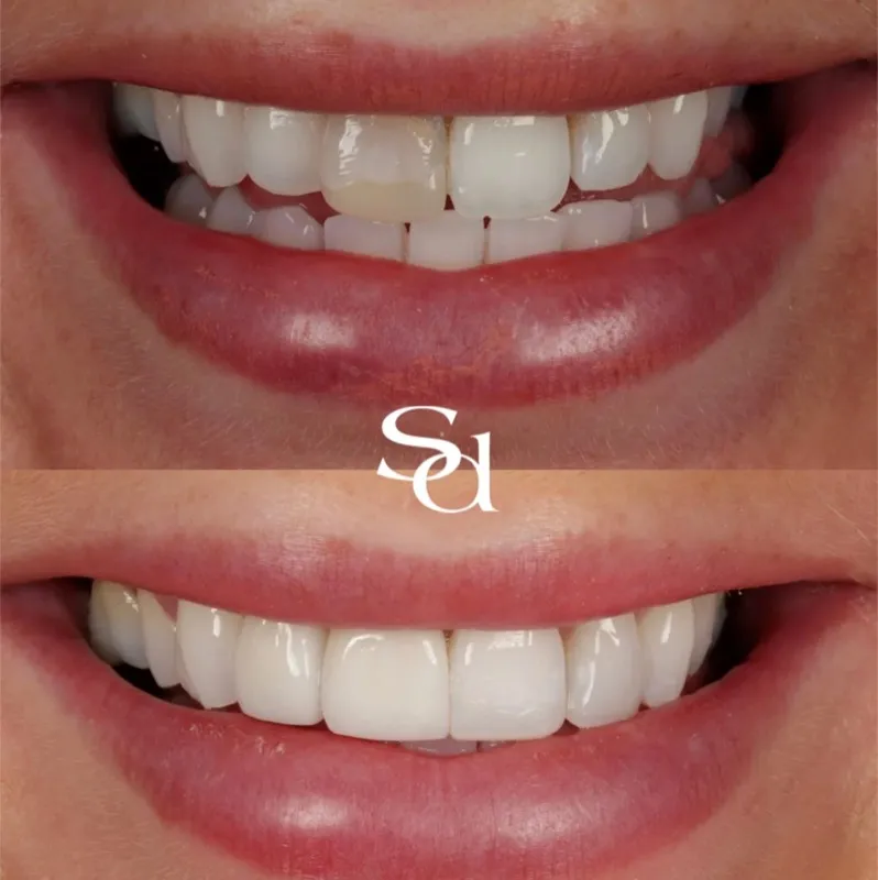 Before and after smile transformation, a real Sale Dental Spa patient