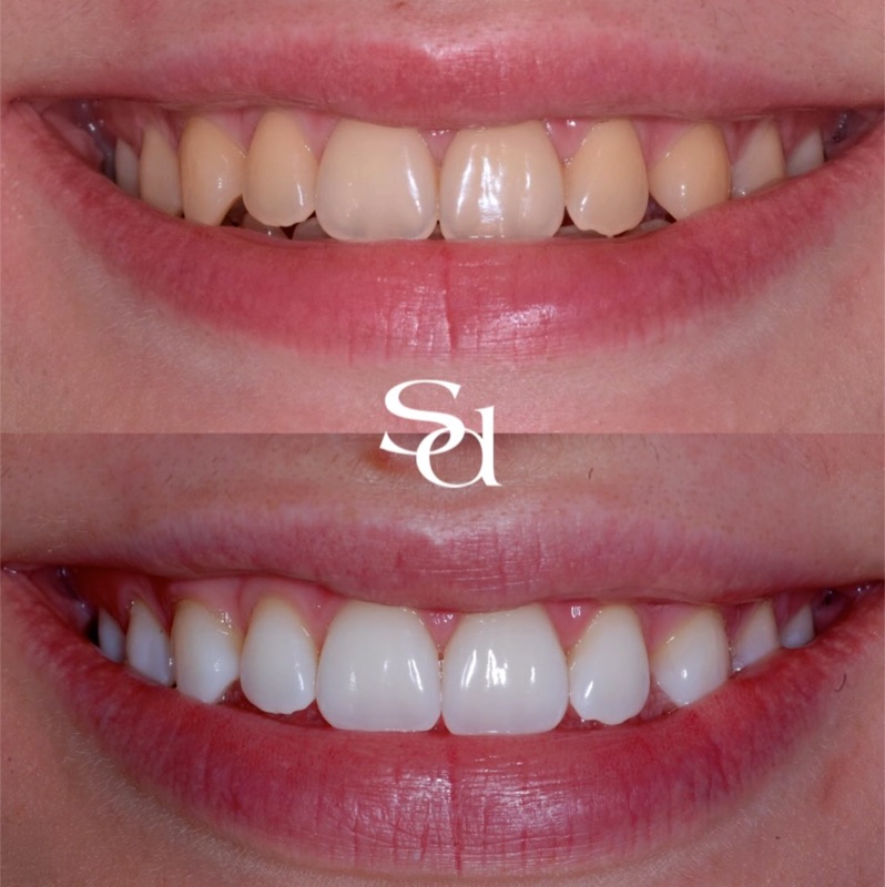 Before and after smile makeover, a real Sale Dental Spa patient