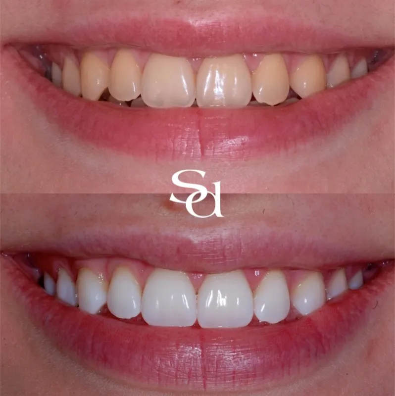Before and after smile makeover, a real Sale Dental Spa patient