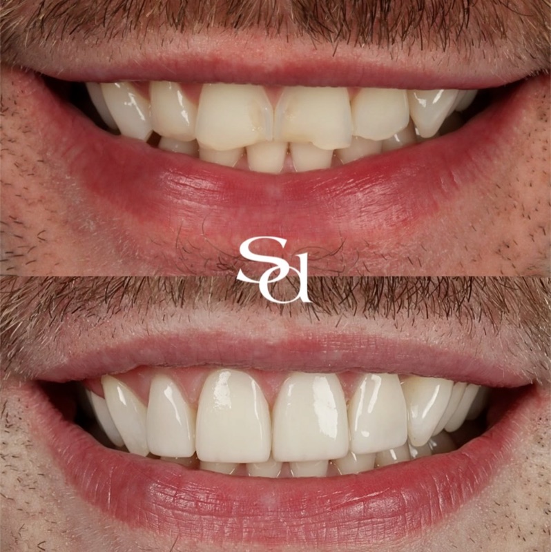 Before and after, a real Sale Dental Spa patient