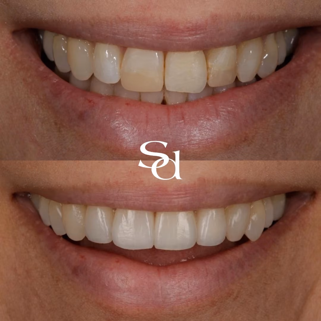 Smile makeover before and after at Sale Dental Spa: discoloured front teeth replaced with a uniform, natural smile, by Dr Hamza Mirza. Un-retouched.