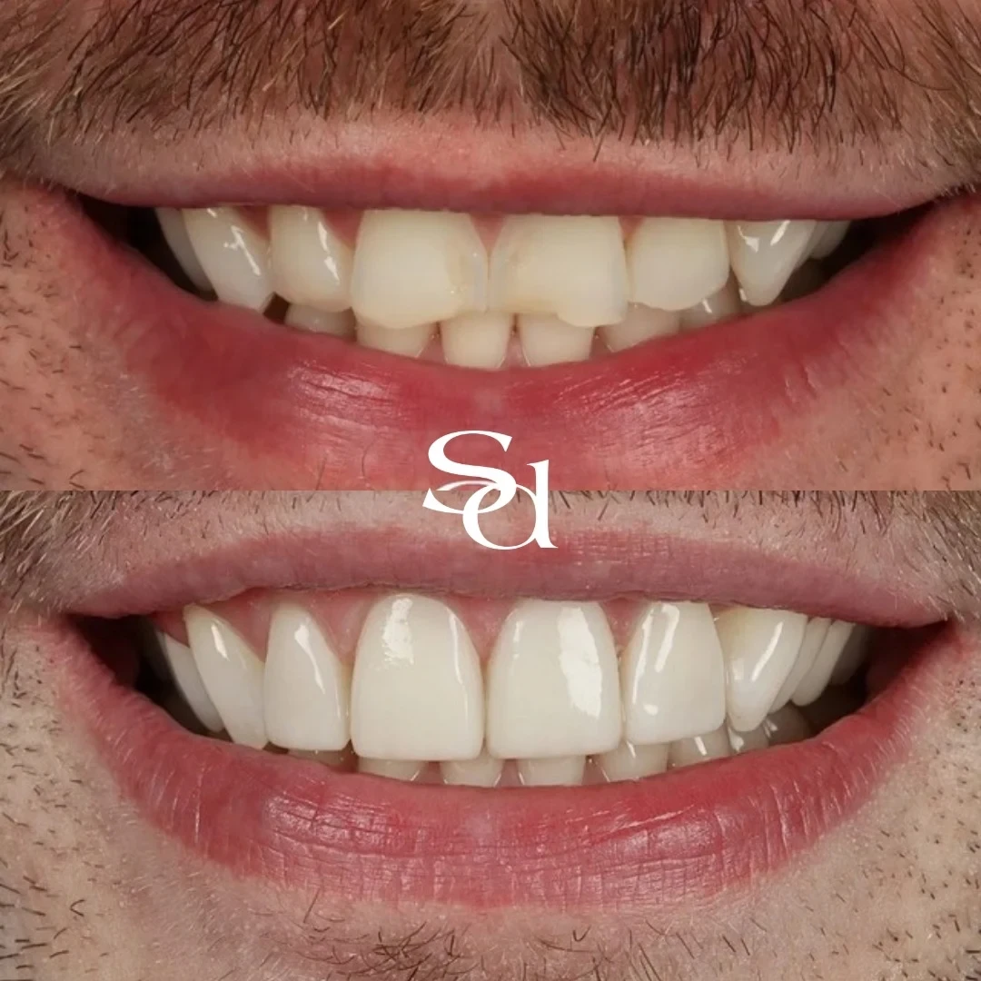 Before and after porcelain veneers at Sale Dental Spa, un-retouched