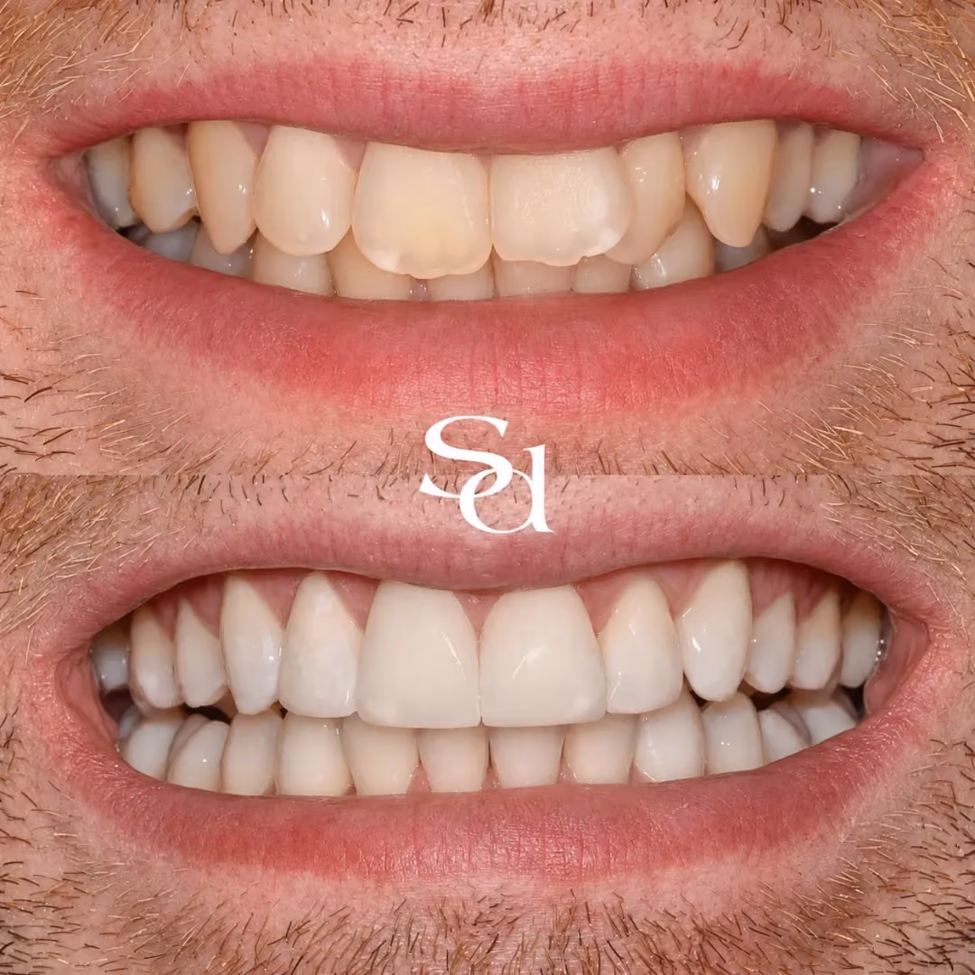 Invisalign and composite bonding before and after at Sale Dental Spa: straighter, fuller smile after Invisalign and composite bonding, by Dr Aisha Ahmed. Un-retouched.
