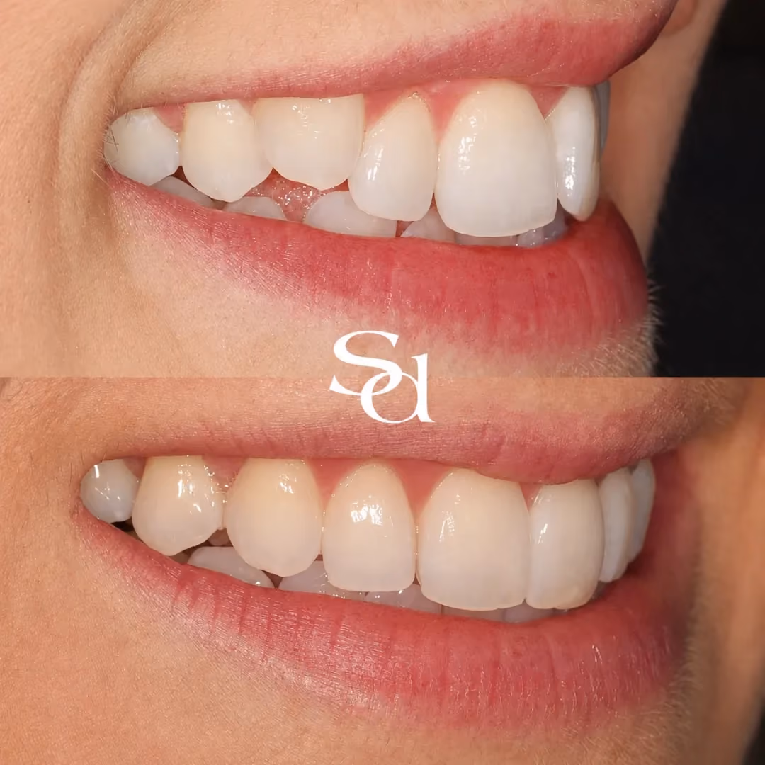 Invisalign before and after at Sale Dental Spa: crowded teeth aligned with Invisalign clear aligners, by Dr Aisha Ahmed. Un-retouched.