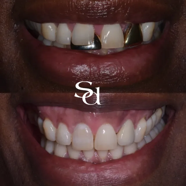 Before and after of a Sale Dental Spa patient treated by Dr Aisha Ahmed