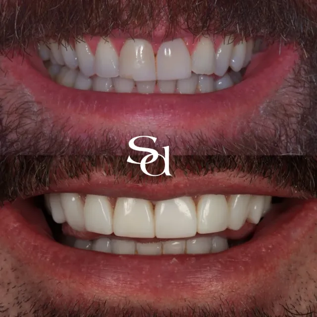 Before and after of a Sale Dental Spa patient treated by Dr Aisha Ahmed