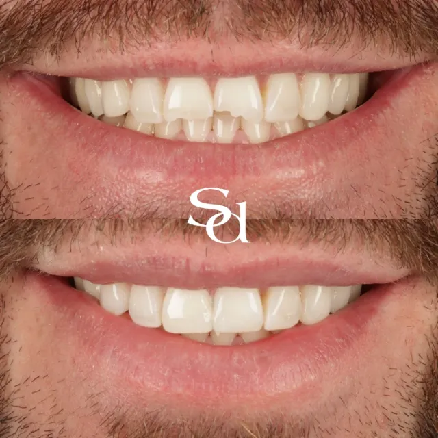 Before and after of a Sale Dental Spa patient treated by Dr Aisha Ahmed