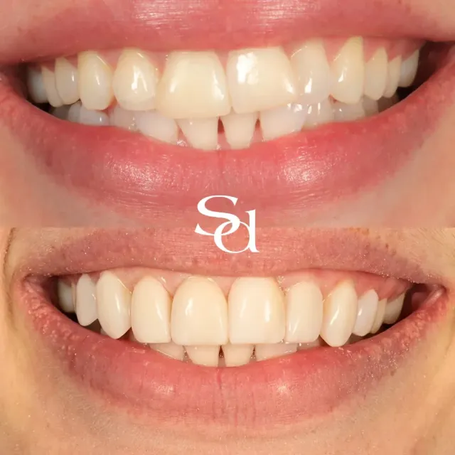 Before and after of a Sale Dental Spa patient treated by Dr Aisha Ahmed